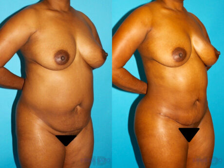 Brazilian Butt Lift case #4642