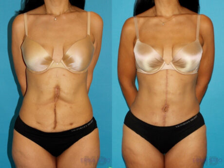 Post Bariatric Surgery (Massive Weight Loss) case #6775