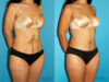 Post Bariatric Surgery (Massive Weight Loss) case #6775 slider thumbnail