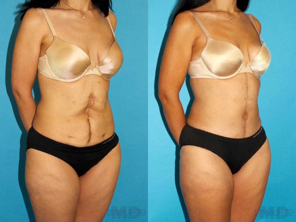 Post Bariatric Surgery (Massive Weight Loss) case #6775