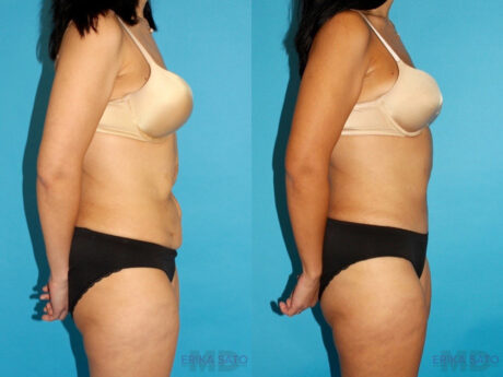 Post Bariatric Surgery (Massive Weight Loss) case #6775