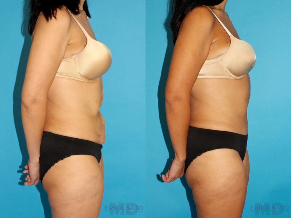 Post Bariatric Surgery (Massive Weight Loss) case #6775