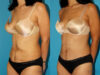 Post Bariatric Surgery (Massive Weight Loss) case #6775 slider thumbnail