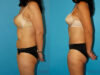Post Bariatric Surgery (Massive Weight Loss) case #6775 slider thumbnail