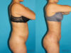 Brazilian Butt Lift case #4671 slider thumbnail
