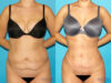 Brazilian Butt Lift case #4671 slider thumbnail