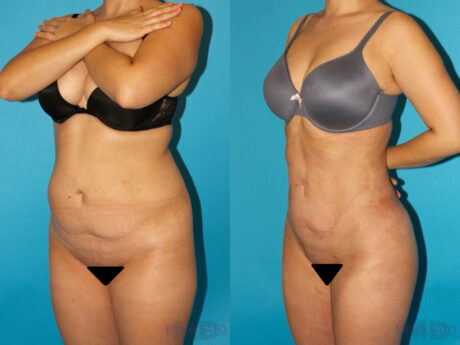 Brazilian Butt Lift case #4671