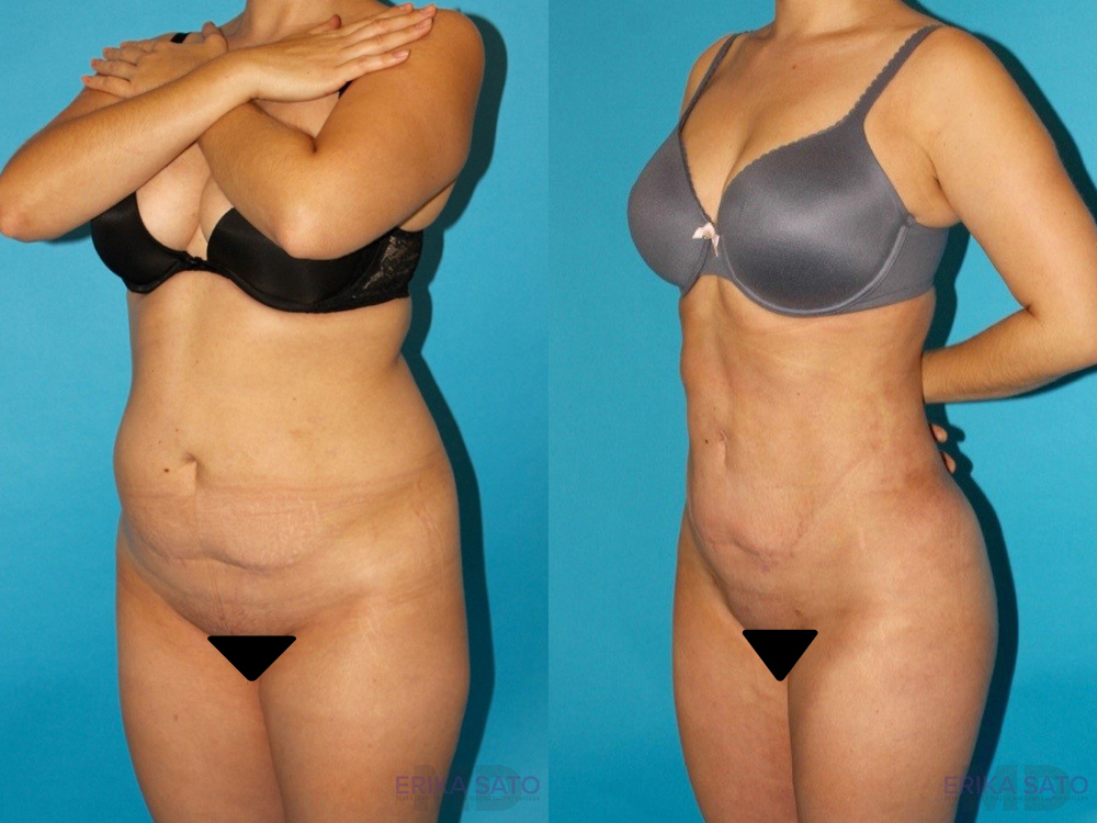 Brazilian Butt Lift case #4671