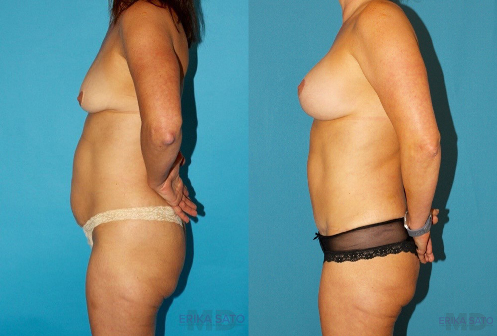 Mommy Makeover case #6506