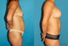 Mommy Makeover case #6506 slider thumbnail