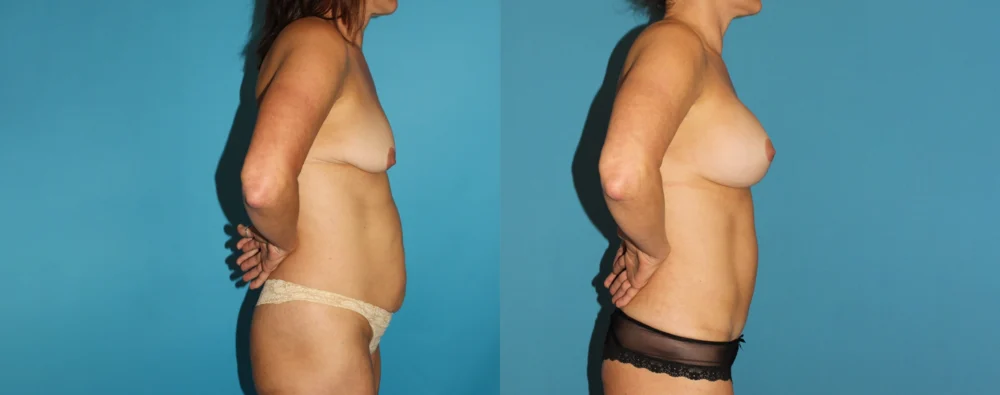 Mommy Makeover case #6506