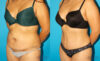 Tummy Tuck case #7281 slider thumbnail