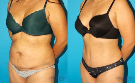Tummy Tuck case #7281