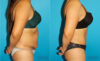 Tummy Tuck case #7281 slider thumbnail