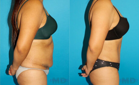 Tummy Tuck case #7281