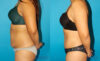 Tummy Tuck case #7281 slider thumbnail