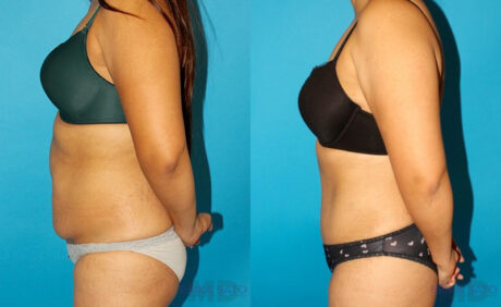 Tummy Tuck case #7281