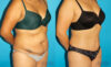 Tummy Tuck case #7281 slider thumbnail