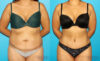 Tummy Tuck case #7281 slider thumbnail