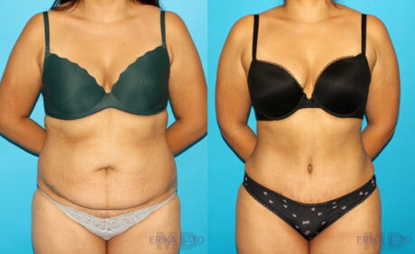 Tummy Tuck case #7281