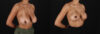 Breast Reduction case #8025 slider thumbnail