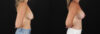 Breast Lift with Implants case #7903 slider thumbnail