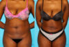 Brazilian Butt Lift case #4762 slider thumbnail