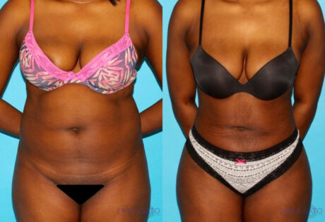 Brazilian Butt Lift case #4762