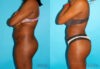 Brazilian Butt Lift case #4762 slider thumbnail