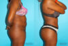 Brazilian Butt Lift case #4762 slider thumbnail
