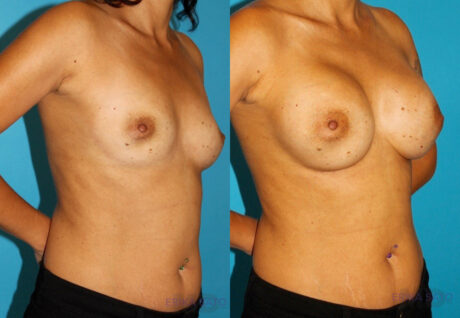 Breast Augmentation case #5653