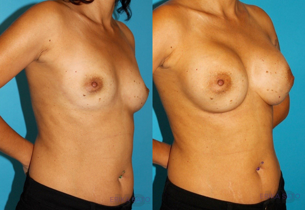 Breast Augmentation case #5653