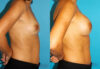 Breast Augmentation case #5653 slider thumbnail