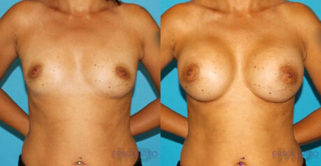 Breast Augmentation case #5653