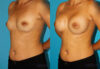 Breast Augmentation case #5653 slider thumbnail