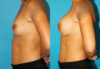 Breast Augmentation case #5653 slider thumbnail
