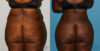 Brazilian Butt Lift case #4445 slider thumbnail