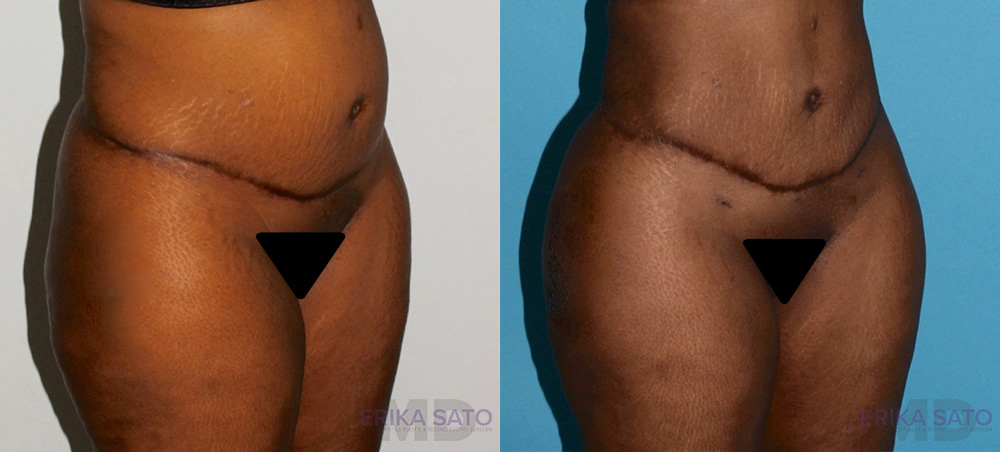 Brazilian Butt Lift case #4445