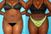 Brazilian Butt Lift case #4672 slider thumbnail