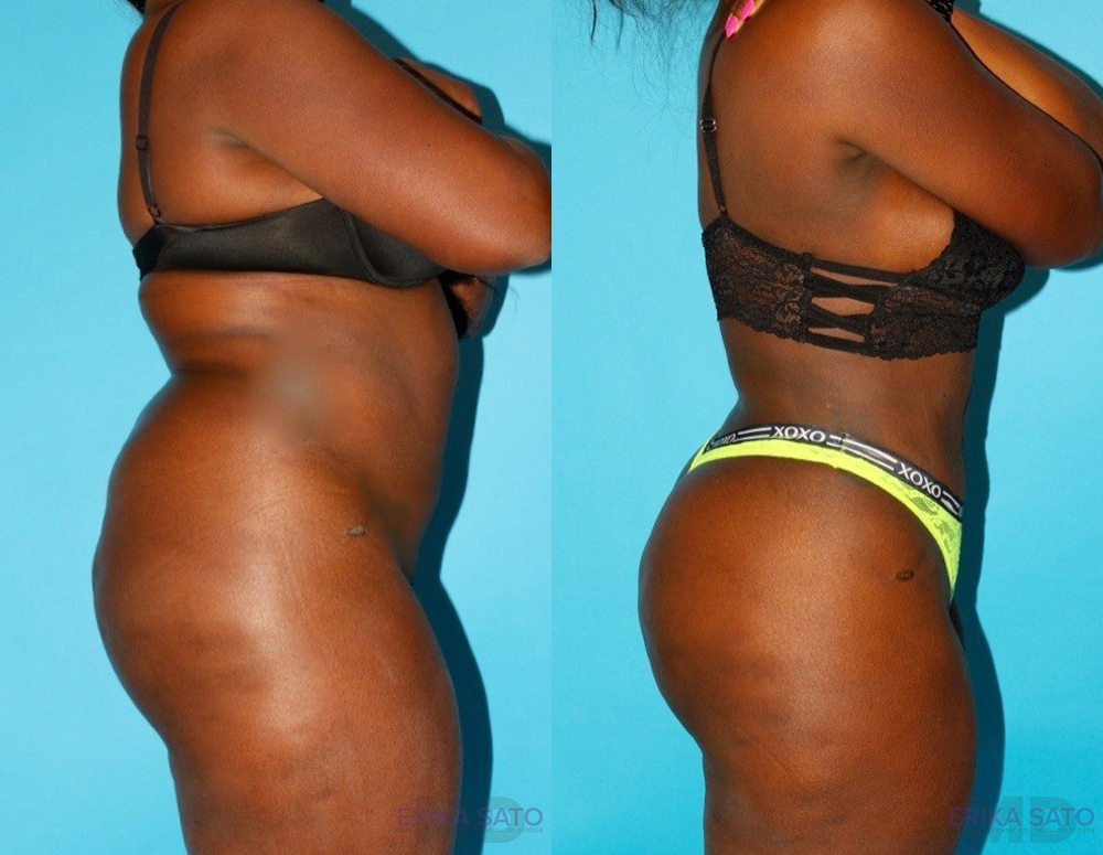 Brazilian Butt Lift case #4672