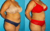 Tummy Tuck case #7234 slider thumbnail