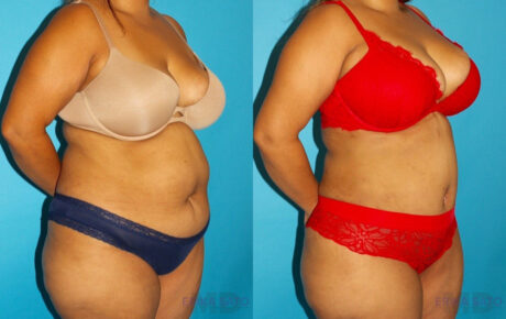 Tummy Tuck case #7234