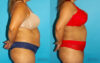 Tummy Tuck case #7234 slider thumbnail