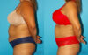 Tummy Tuck case #7234 slider thumbnail