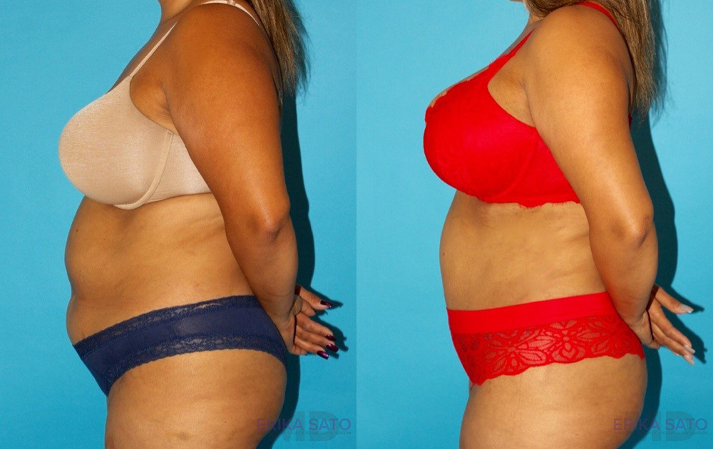Tummy Tuck case #7234