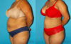 Tummy Tuck case #7234 slider thumbnail
