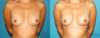Fat Grafting to the Breast case #256155 slider thumbnail