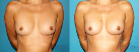 Fat Grafting to the Breast case #256155
