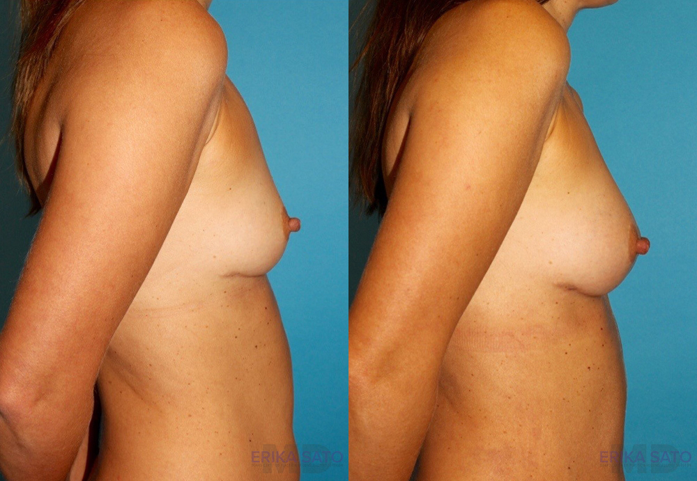 Fat Grafting to the Breast case #256155