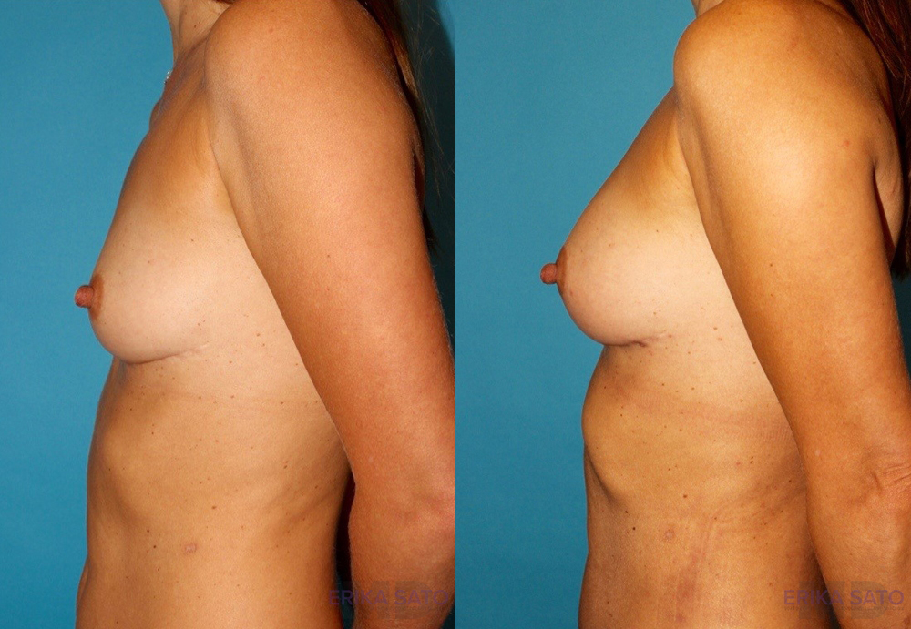 Fat Grafting to the Breast case #256155